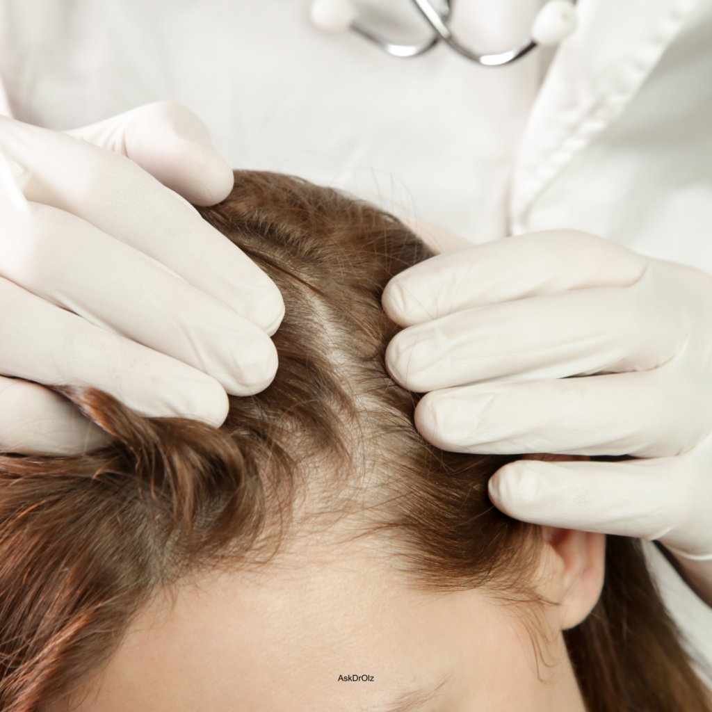 PCOS hair loss