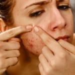 cystic acne south africa
