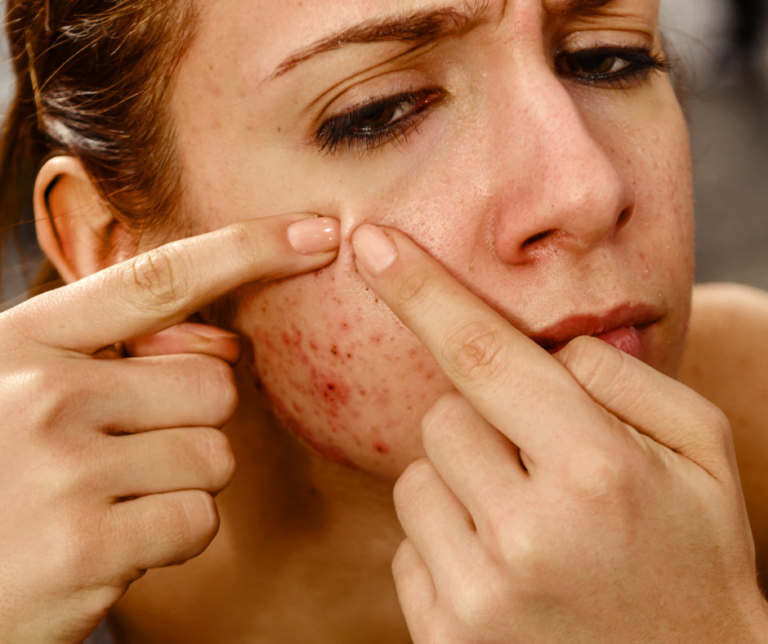 cystic acne south africa