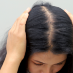 hair thinning at the crown