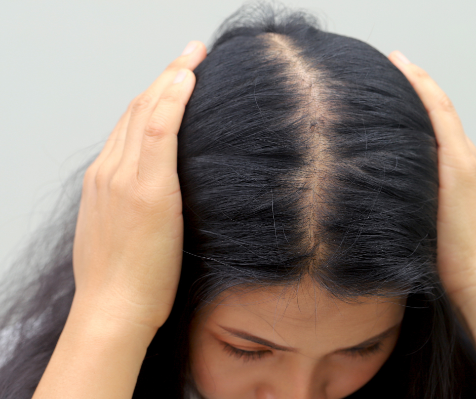 hair thinning at the crown